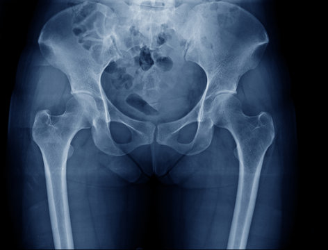 hip and pelvic bone x-ray