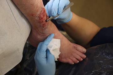 Wound on the leg