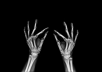 x-ray image hand and finger