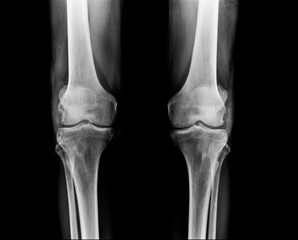 x-ray OA knee