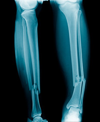 x-ray fracture leg