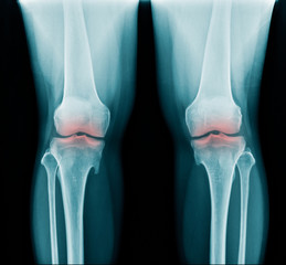 x-ray OA knee