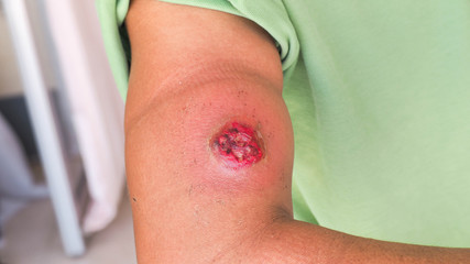 upper arm with infection wound and abscess. 