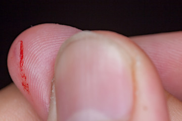 The wound was hit by a knife.