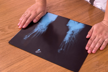 X-ray of patient's foot on the table with doctor's hands