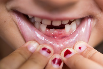 Close-up of a girl's teeth with tooth gap and tooth eruption