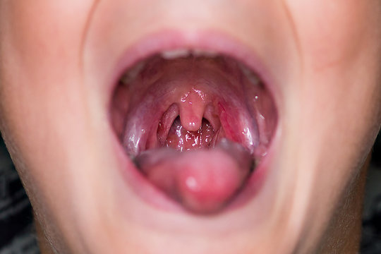 Chronic tonsillitis. Herpes