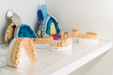 A prosthetic saddle in a dental laboratory