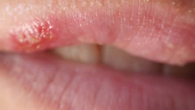 ulcers from herpes on female lips macro. Colds on the lips.