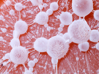 cancer tumour.