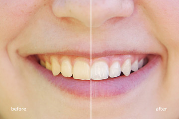teeth whitening before and after concept. comparison between yellow and white teeth side by side.