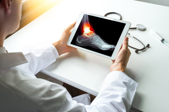 Doctor watching x-ray of sprained or broken ankle with pain on a digital tablet