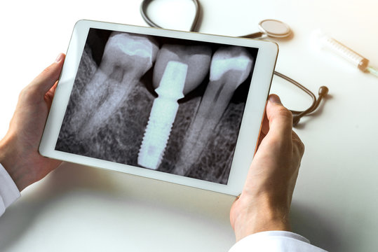 Dentist watching a dental x-ray teeth with dental pivot on digital tablet. Radiology concept