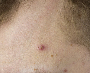 Naklejka premium Big red pimple on the man's forehead, close-up, problem skin, white-head