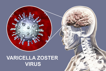 Varicella zoster virus VZV encephalitis, medical concept, 3D illustration showing brain infection and close-up view of VZV in the brain. Encephalitis is one of complications of chickenpox