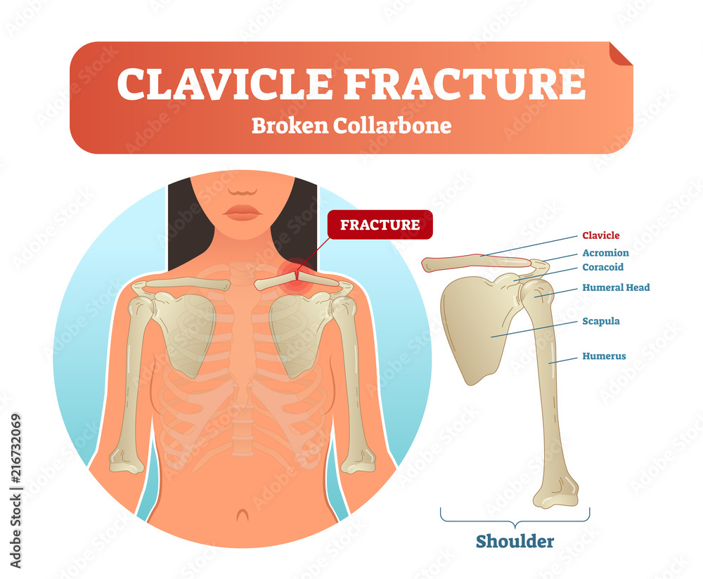 Wall mural Clavicle fracture with broken collarbone vector illustration. Medical and anatomical labeled scheme with clavicle fracture, acromion, humeral head, scapula and humerus.