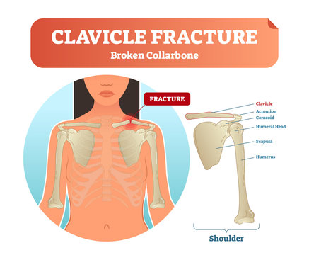 Clavicle fracture with broken collarbone vector illustration. Medical and anatomical labeled scheme with clavicle fracture, acromion, humeral head, scapula and humerus.