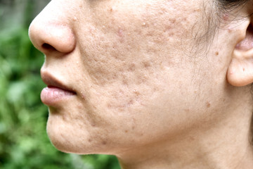 Skin problem with acne diseases, Close up woman face with whitehead pimples, Menstruation breakout,...