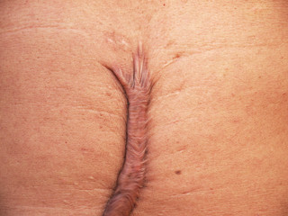 scar on his stomach after surgery