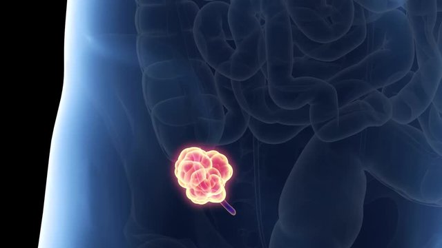 medically accurate 3d animation of appendix cancer