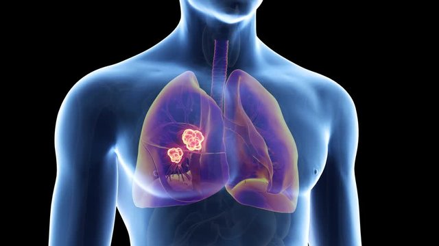 medically accurate 3d animation of lung cancer