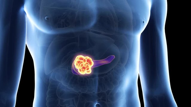 medically accurate 3d animation of pancreas cancer