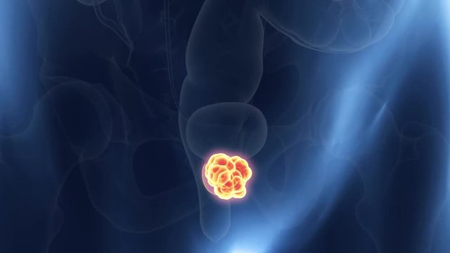 medically accurate 3d animation of prostate cancer
