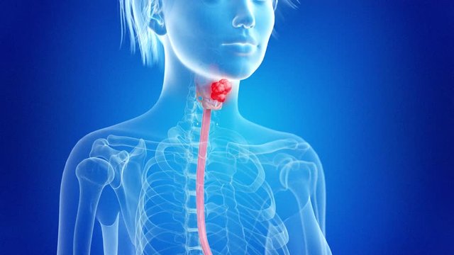 medically accurate 3d animation of larynx cancer