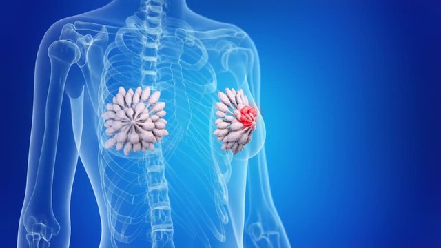 medically accurate 3d animation of breast cancer
