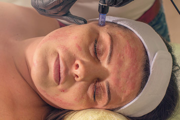 Needle mesotherapy treatment on a woman face.