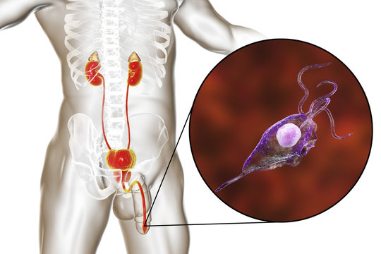 Trichomoniasis infection in man, 3D illustration showing male anatomy genitourinary system and close-up view of Trichomonas vaginalis protozoan causing urethritis