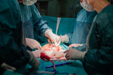 Hysterectomy surgery.