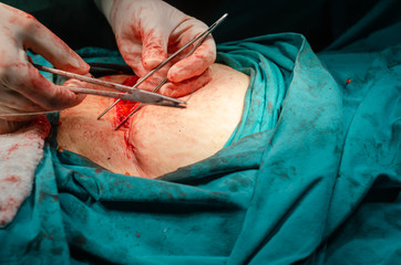A surgeon is stitching a wound after an operation in a hospital