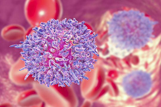 Hairy cell leukemia, 3D illustration. It is a hematological malignancy, chronic lymphocytic leukemia, with accumulation of abnormal B lymphocytes