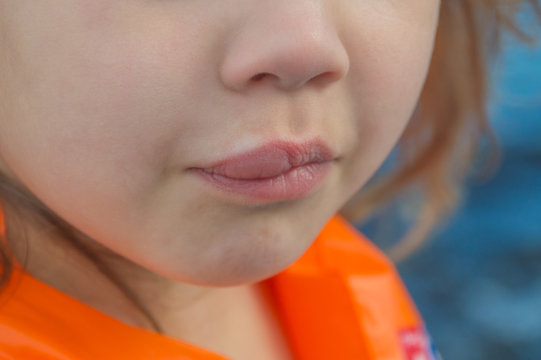  child the bite of a bee in the lip, swollen
