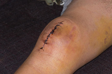 Male knee after meniscal surgery with medical suture