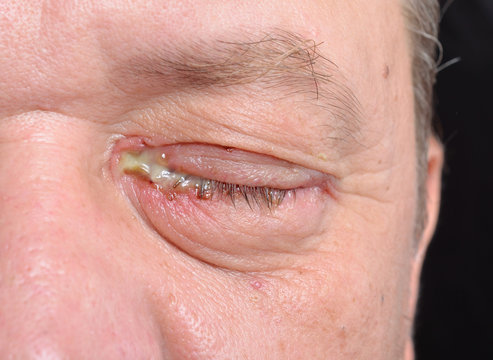 An eye with bacterial purulence conjunctivitis, also known as pink eye