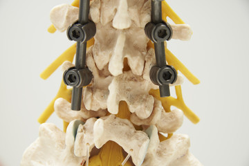 Model of instrument fixation of human lumbar spine model