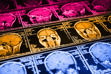 Magnetic resonance scan of the brain. MRI head scan