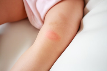 baby skin rash and allergy with red spot cause by mosquito bite at knee