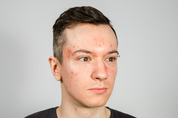 Naklejka premium Portrait of young guy with allergy, with redness face. Close-up.