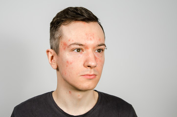 Fototapeta premium Portrait of young guy with allergy, with redness face