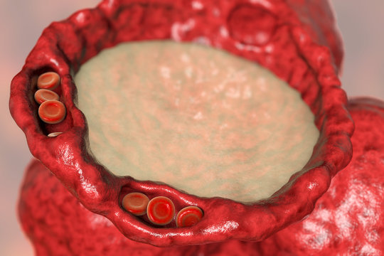 Pulmonary edema, close-up view of alveolus cross-section showing liquid in alveolus, dilated capillaries and thickened alveolar wall, 3D illustration
