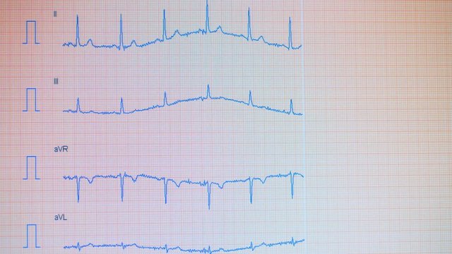 Screen with electrocardiographic curvatures getting drawn on it. Heart pulse line.