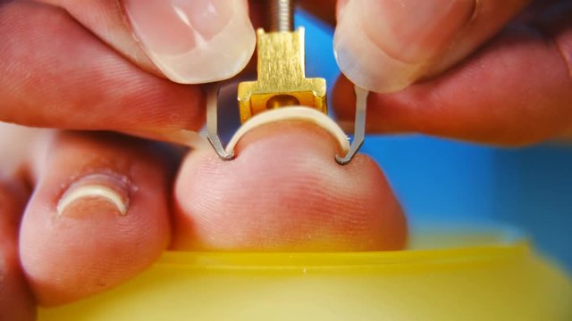 Person put on Ingrown Pedicure Straightener Clipper macro shot 4K. Low angle close-up of person toenail in focus while applying a pedicure straightener tool on to the curved ingrown nail. 