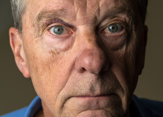 Senior caucasian man with a black eye