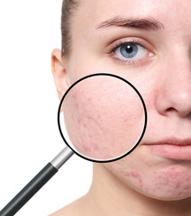Young woman with acne problem on white background
