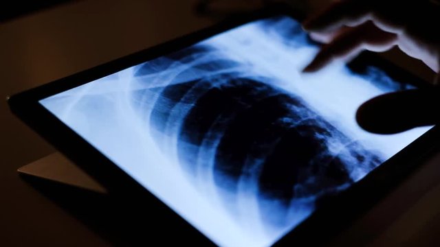 Doctor analyzing cancer chest lungs x-ray tommography medical data on touchscreen computer, work late at night, working with modern digital technology in hospital concept; coronavirus pneumonia test