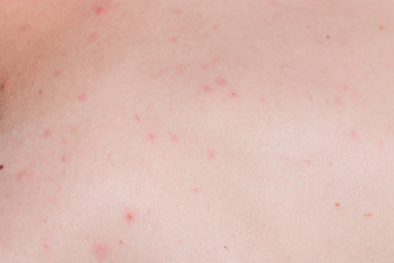 Acne on the skin - medical, cosmetic background, the concept of skin cleansing