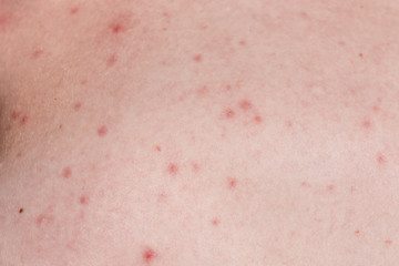 Fototapeta premium Acne on the skin - medical, cosmetic background, the concept of skin cleansing